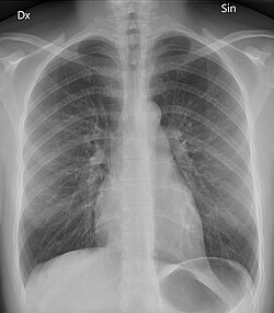 Normal Matrix — Translucent lung fields
