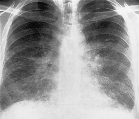 Viral Matrix — Diffuse interstitial pattern